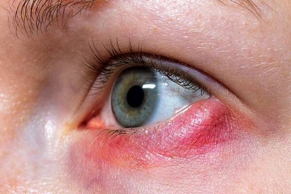 Styes: Causes, Symptoms, Treatment, Prevention