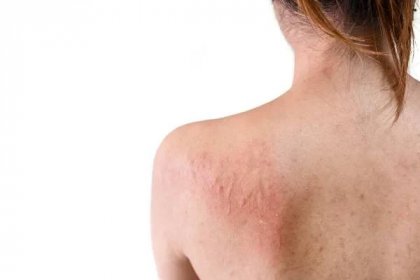 Zadní část mladé asijské ženy mají svědění s alergií vyrážka na bílém pozadí, Selektivní zaměření, Zdravotní alergie kožní péče. — Stock obrázek