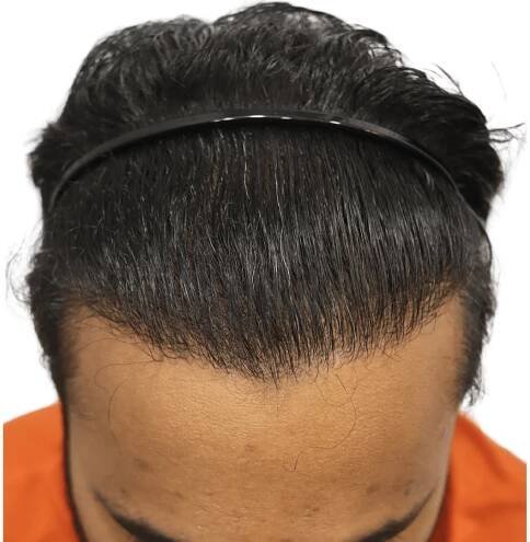 No.1 Hair Transplant Clinic in Ahmedabad | Dr. Aanchal Shah | Zeeva Clinic