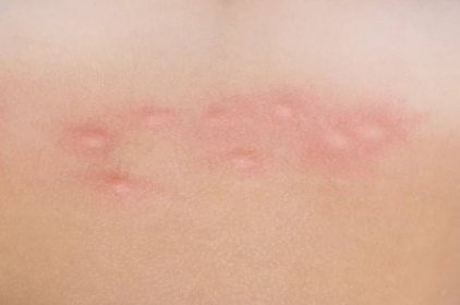 Komár kousne na kůži — Stock fotografie