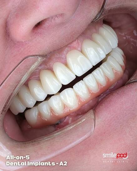 all-on-five-dental-implants-turkey-before-and-after-01