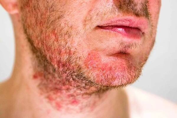 Seboroická dermatitida je poměrně časté neinfekční onemocnění kůže, které mívá chronický a recidivující průběh. 