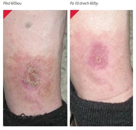 Kyselina fusidová a její galenické formy v dermatologii