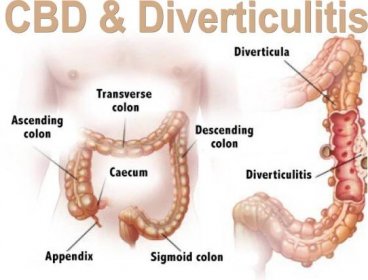 Diverticulitis and CBD