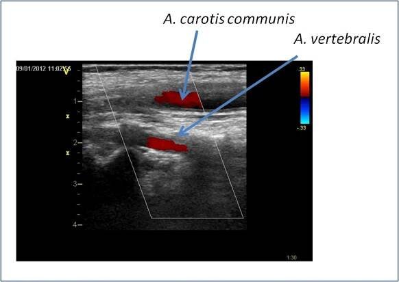 Vyšetřovací metody: Vyšetření cév, ultrazvuk ve vyšetření cév « Tvorba a ověření e-learningového prostředí pro integraci