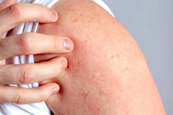 Co způsobuje exacerbaci atopické dermatitidy?