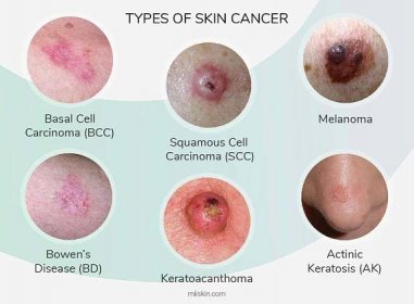 Rakovina kůže: příznaky, příčiny a léčba