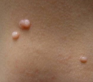 Molluscum Contagiosum 101: How Long Does it Live on Surfaces