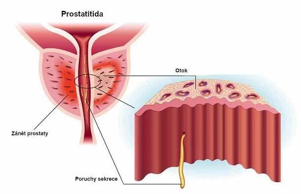Prostatitida-zánět_prostaty