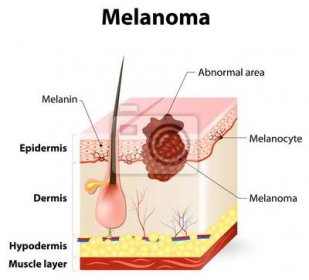 rakovina kůže. melanom