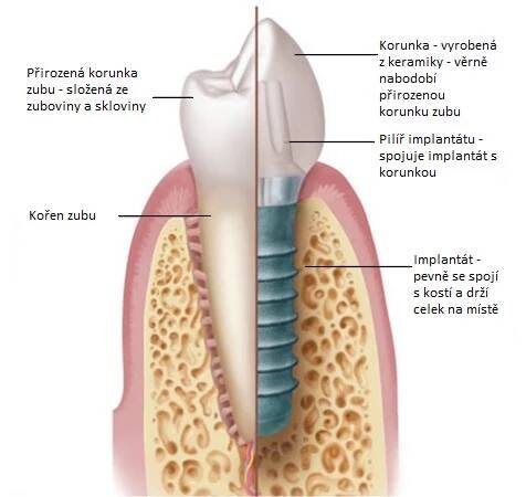 zub vs. implantát