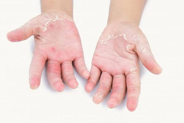 The ‘Total Body’ Management of Psoriasis - The Hair Loss Clinic