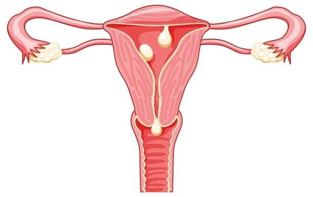 polypy v děloze - cervikální, pedunkulované a přisedlé ženský reprodukční systém v průřezu. pohled zepředu v řezu. lidská anatomie nemoci vnitřních org ánů umístění schéma plochý styl ikona - pochvy ženská rozmnožovací soustava ilustrace stock ilustrace