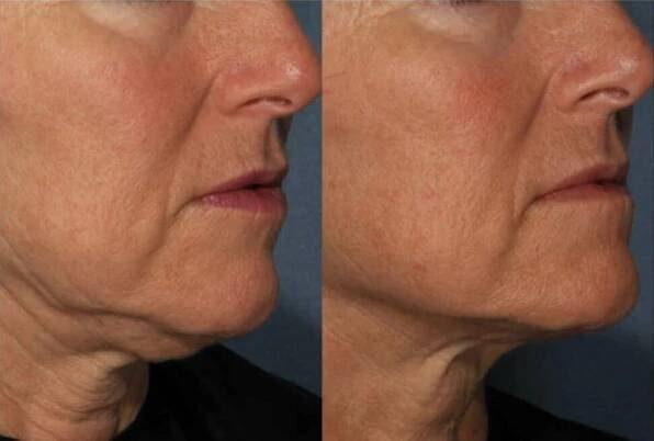 Exilis Elite, vyhlazení spodní části obličeje, podbradku a krku, Beauty studio Dana, Praha 9