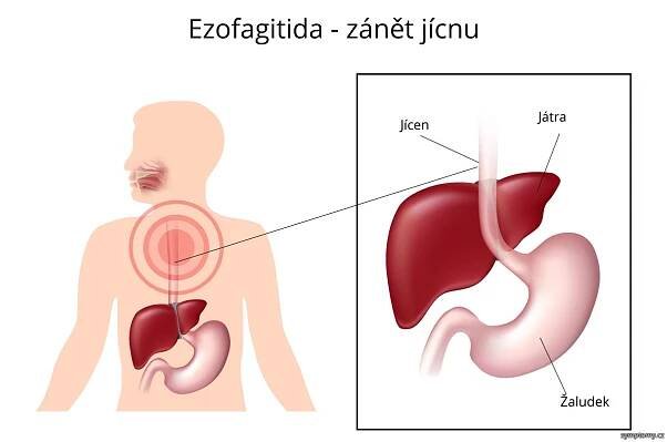 Ezofagitida - příznaky a léčba