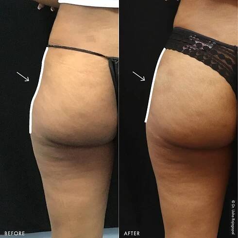 sculptra_bbl_17.jpg