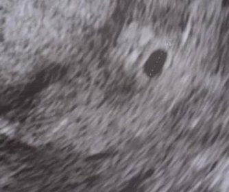 Těhotenství | Je vidět pouze gestační vacek 5+5tt
