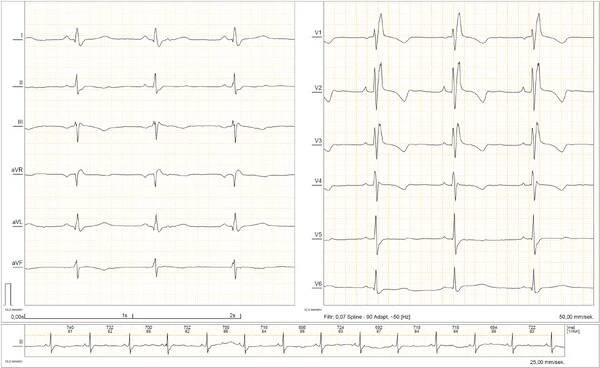 EKG (pediatrie) – WikiSkripta