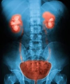 rentgenový snímek ledvin, močotu a bladde (kub) - kidney stone xray - stock snímky, obrázky a fotky