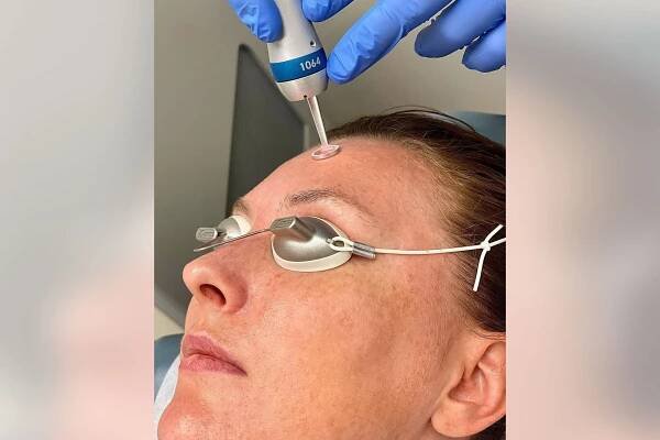 Discover the Benefits of Fractionated CO2 Laser Treatments