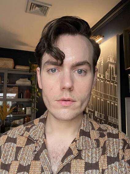 Turner Allen, 32, before a hair transplant and PRP treatments. 
