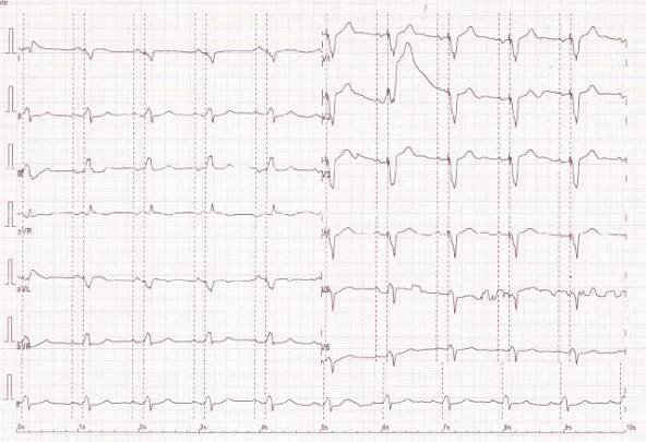 (EKG Kazuistika) Pacemakerový syndrom - Kardioblog
