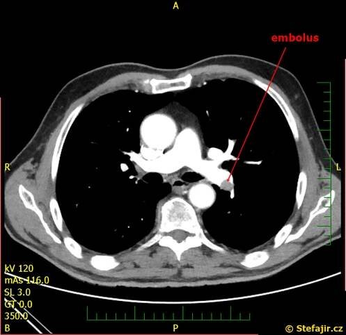 Nález 15 - Plicní embolie | Medicína, nemoci, studium na 1. LF UK