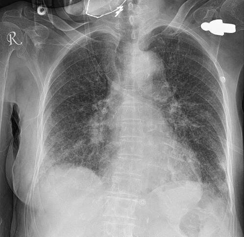 Aspiration-pneumonia-5.jpg