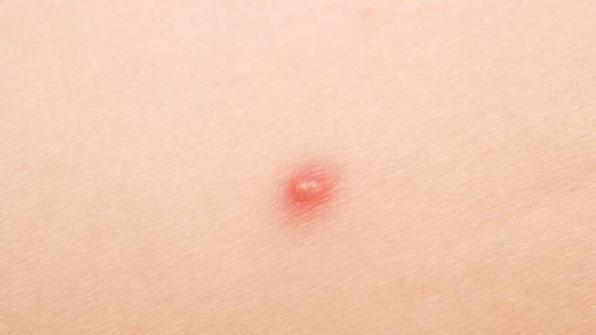 A Short Guide To Six Different Types of Acne (And How To Treat Each One)