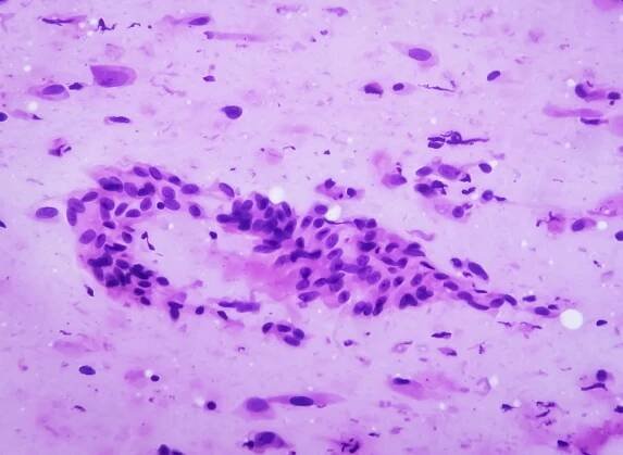 mikrosnímek ukazující neurofibrom. neurofibromatóza je genetická porucha, genové mutace. - neurofibromatóza - stock snímky, obrázky a fotky