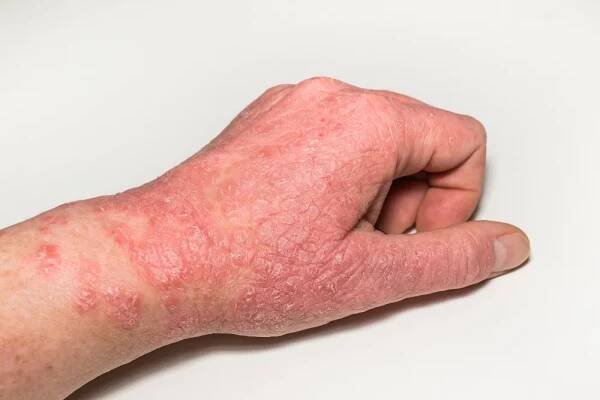 Alergické kožní léze na ruce s prasklinami, zánětem a odlupováním. Psoriáza, atopická dermatitida, ekzém. Kožní problémy — Stock obrázek