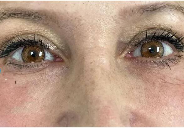 Endolift® Treatment in Land O Lakes FL 
