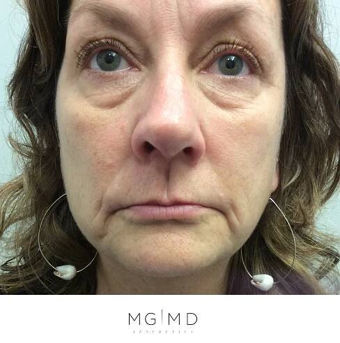 Before and After Tear Trough (under eye) and Lower Face Filler - MGMD Aesthetics