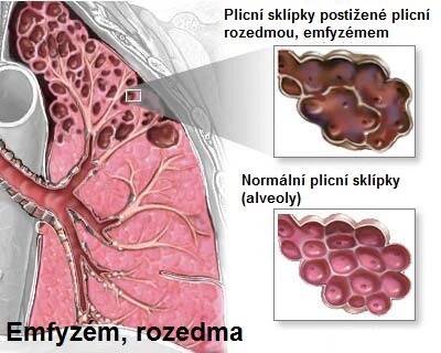 Emfyzém, rozedma plic - příznaky, projevy, symptomy