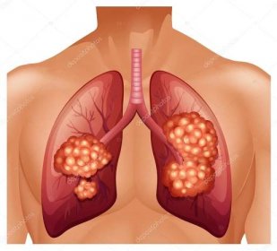 Rakovina plic u člověka Stock Vektor od ©blueringmedia 83404626