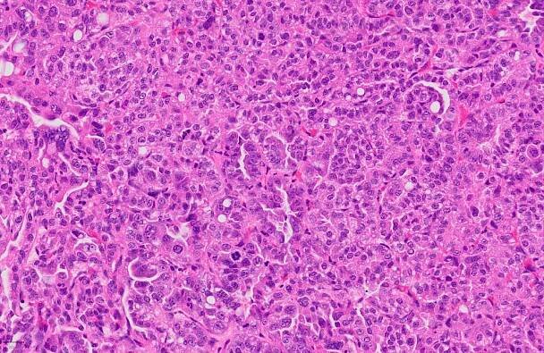 Histologické barvení adenokarcinomu plic