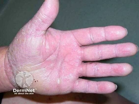 Lichen planus on the palms producing a keratoderma