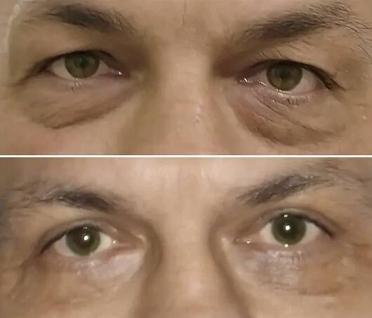 Operace očních víček – foto před a po | Perfect Clinic