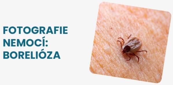 Borelióza fotografie: jak vypadá skvrna typická pro toto onemocnění?