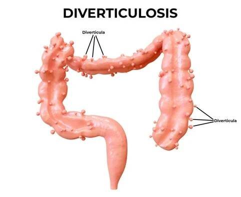 Divertikulóza je gastrointestinální porucha, při které se ve střevě tvoří divertikula. 3D ilustrace — Stock obrázek