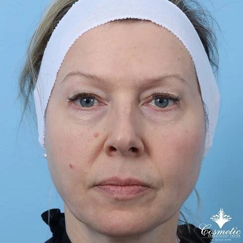 EmFace® Face Toning and Wrinkle Reduction | Cosmetic Dermatology Center