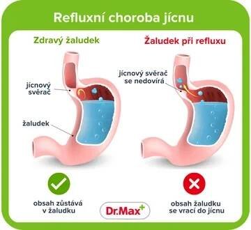 Reflux jícnu