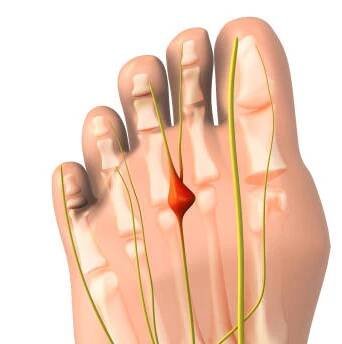 pinched nerve or neuroma medical animation - nárt - stock snímky, obrázky a fotky