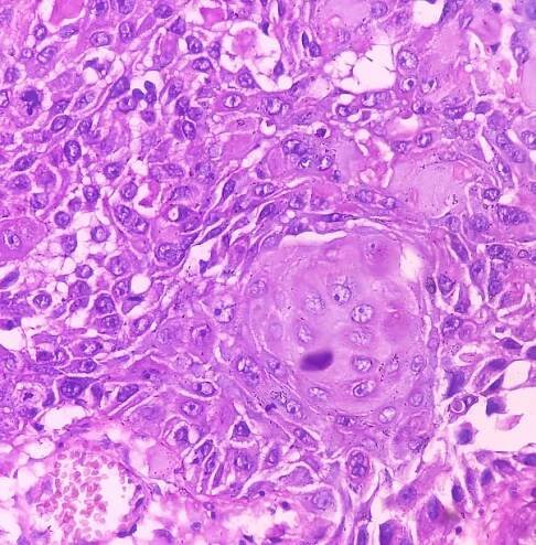 bradavka (biopsie): invazivní spinocelulární karcinom bradavky. mikroskopický obraz ukazuje maligní novotvar. rakovina mužských bradavek. pagetova choroba bradavky. - skvamocelulární karcinom - stock snímky, obrázky a fotky