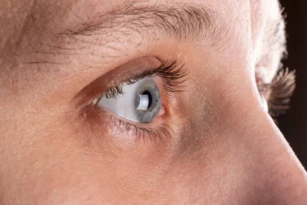 Žena oko s dystrofií rohovky, keratoconus, ztenčení rohovky — Stock obrázek