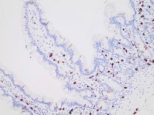 Mastocytosis - Wikipedia