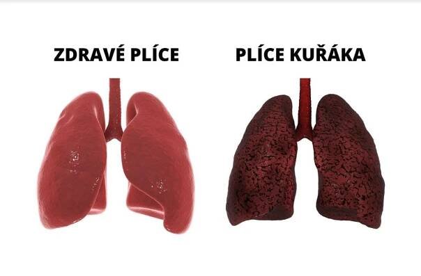 Karcinom plic v 21. století: Boj proti kouření i delší život pacientů 7