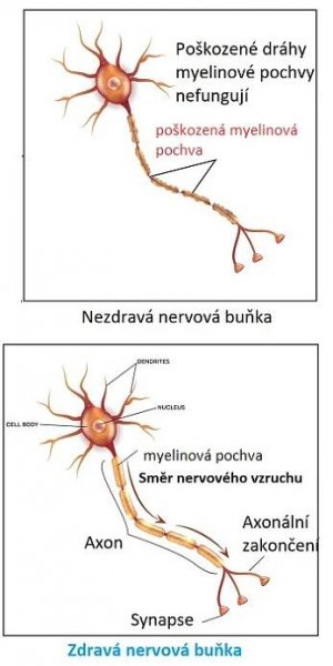 Myelinová pochva - zdravá a poškozená