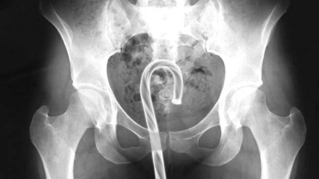 What Did We Get Stuck In Our Rectums Last Year?