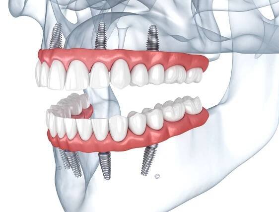 protézy podporované 8 implantáty. dentální 3d ilustrace - zubní protéza - stock snímky, obrázky a fotky